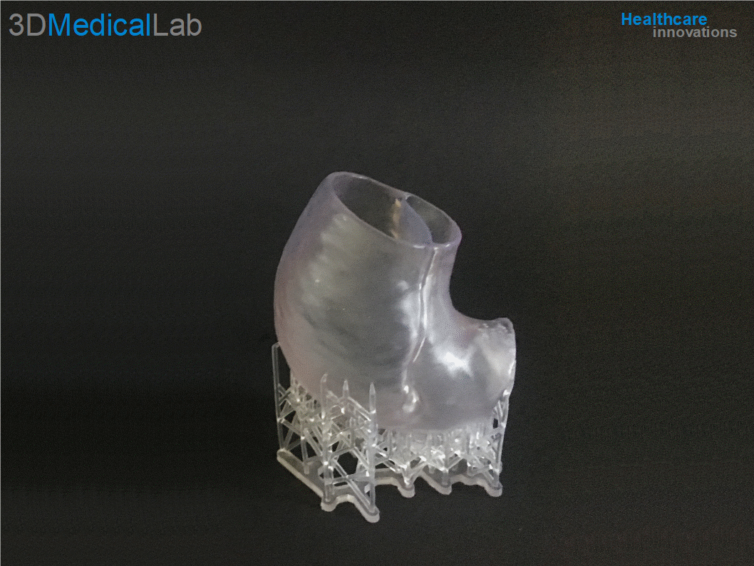 3D Medical Lab is een innovatief Utrechts bedrijf dat wordt geleid door Technisch Geneeskundige. In het figuur is een aortaboog dissectie weergegeven.